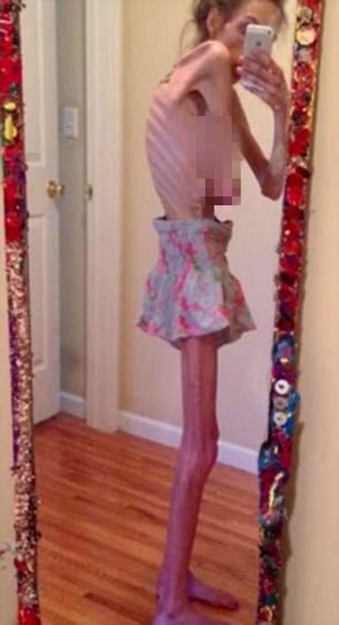 anorexic naked|Anorexic Porn Pics & Naked Photos